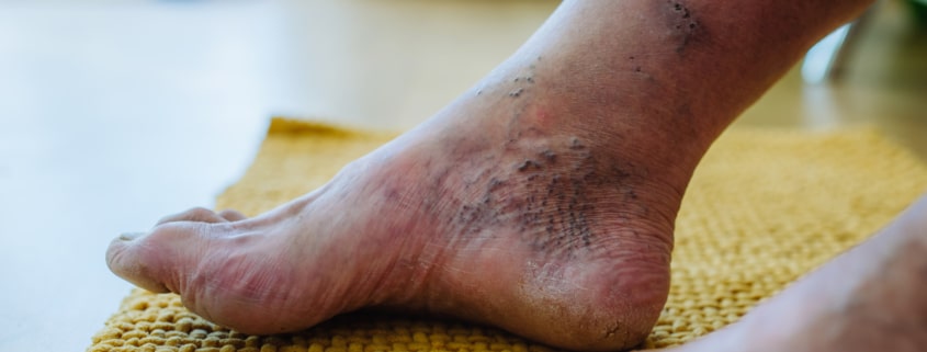 A close up shot of man's feet with diabetic foot complications.