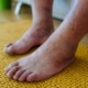piedi gonfi anziani cause rimedi