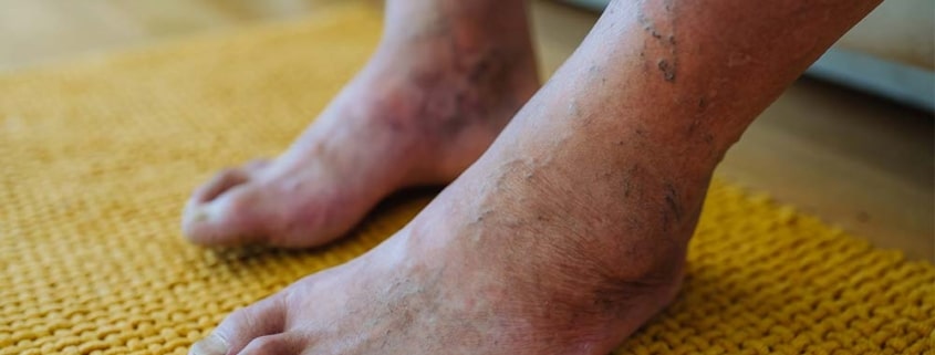 piedi gonfi anziani cause rimedi